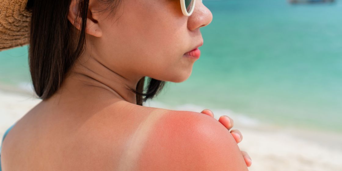 Woman with Sunburn on Back 